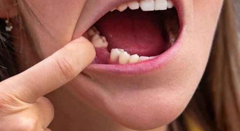 mơ bị gãy răng hàm dưới