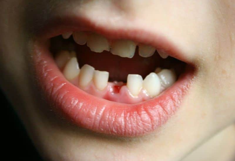 mơ thấy gãy răng cửa
