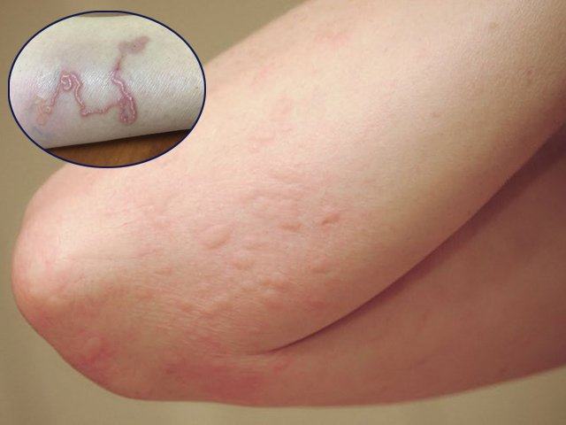 Mơ thấy giun bò lên người là điềm tốt hay xấu ?