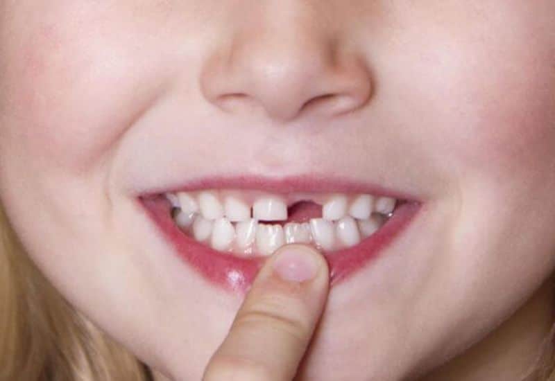 nằm mơ bị gãy răng cửa
