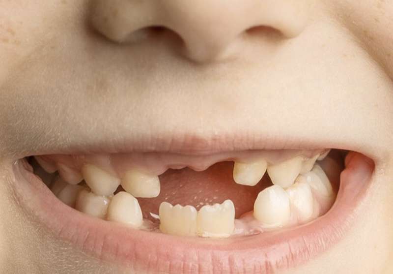 nằm mơ gãy răng không chảy máu