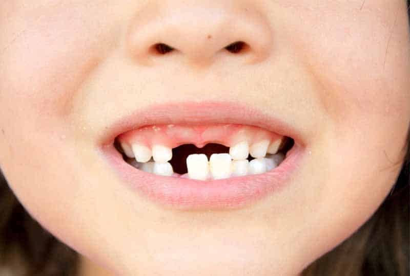 mơ thấy bị gãy răng không chảy máu