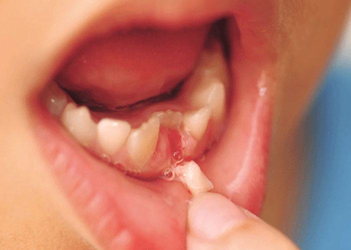 Ý nghĩa giấc mơ thấy mình gãy răng liên quan đến sự nghiệp, tài chính , tình yêu, gia đình và sức khỏe..vv Ý nghĩa giấc mơ thấy mình gãy răng liên quan đến sự nghiệp, tài chính , tình yêu, gia đình và sức khỏe..vv